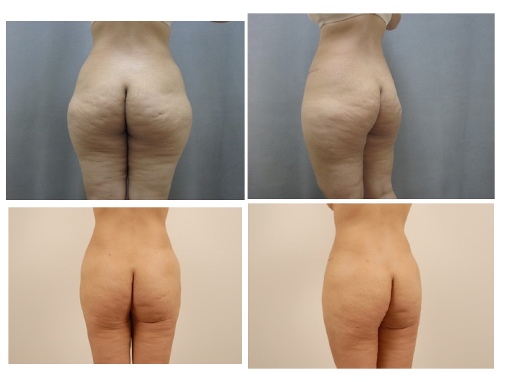 SMARTLIPO